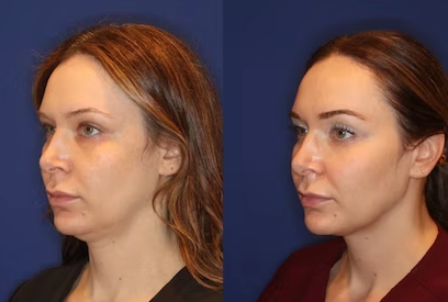 EMFACE anti-wrinkle lifting treatment Course of 4 (save €1,051)