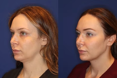 EMFACE anti-wrinkle lifting treatment course of 3 (save €651)