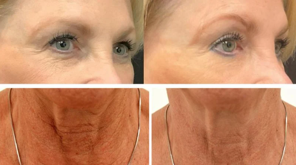 NEW EXION Radio Frequency Wrinkle & Skin Tightening save up to €1,001