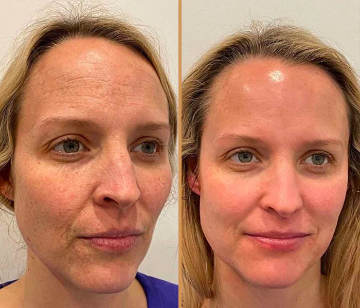 hydrafacial-2-copy-1680180415183.webp__PID:a7b21866-88ab-4d3e-8583-5eecec06ab44