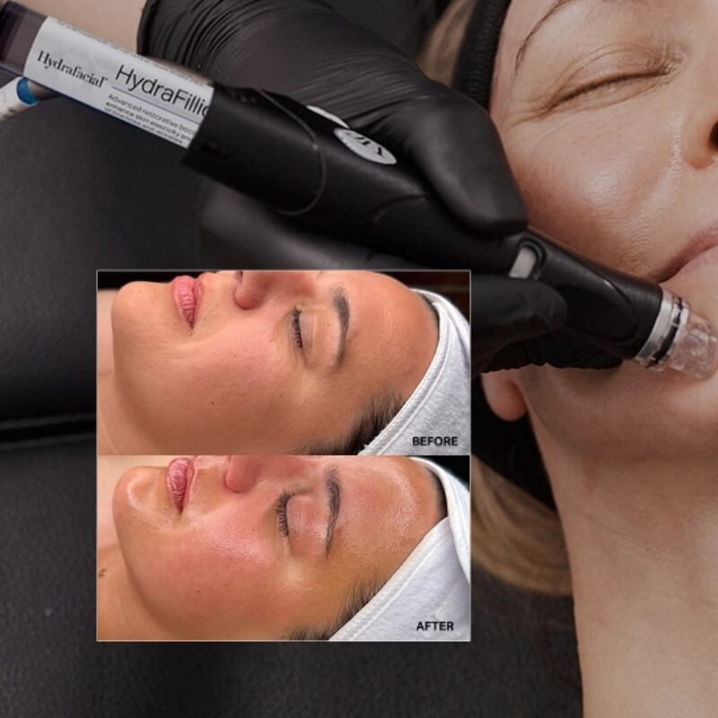 Platinum 6-Step HydraFacial 50-Mins Gift Card (save €51)