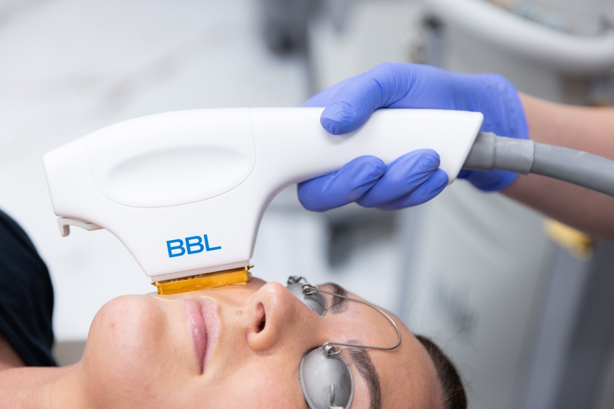 BBL HERO Photofacial Skin Rejuvenation for Face, Neck & Décolleté Course of 4 (save €500)