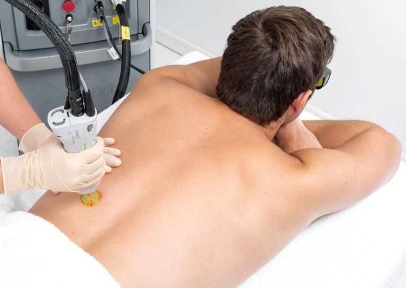 Laser Hair Removal Voucher value €1,000 for Women or Men includes consultation and patch test (save €501)