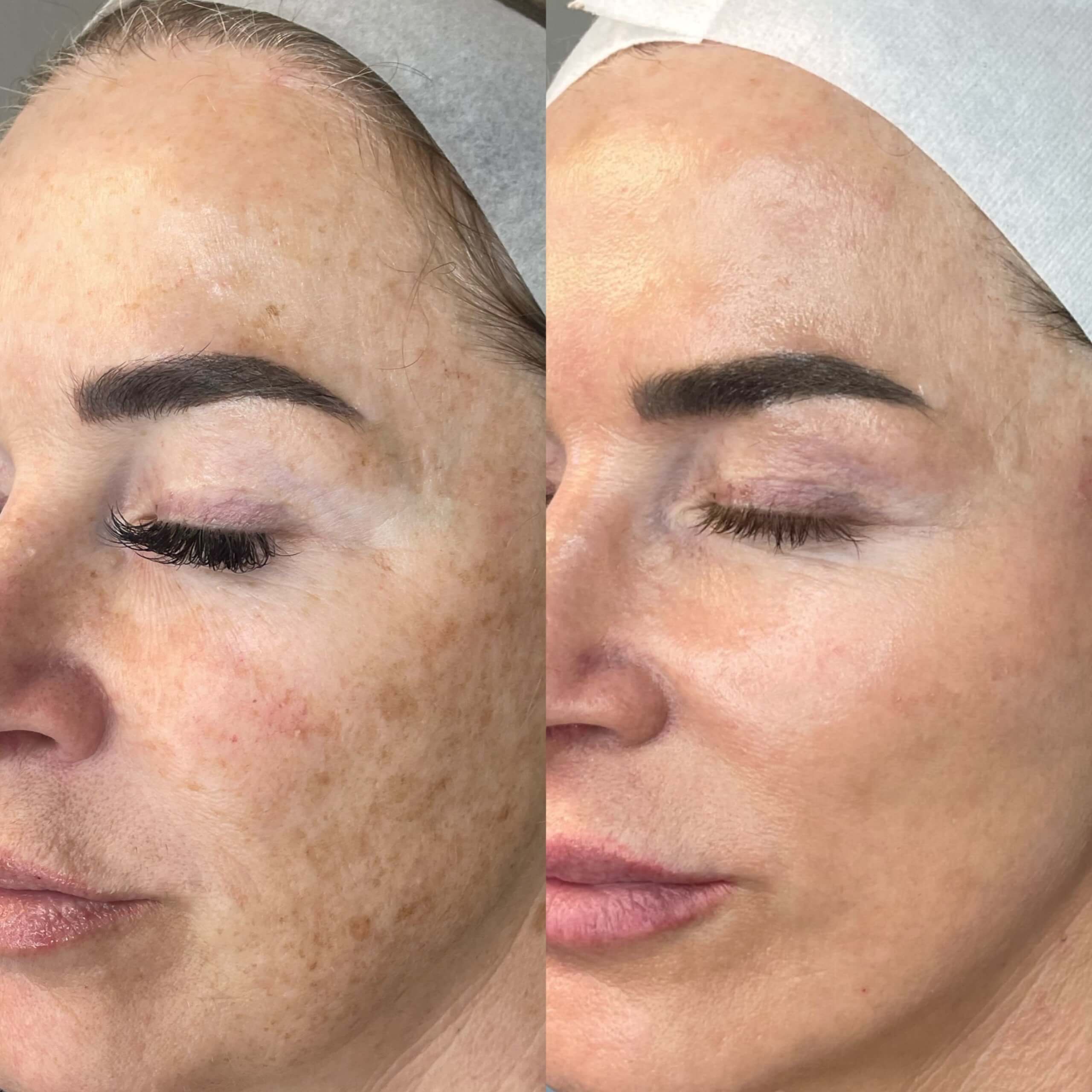 MOXI Laser Skin Rejuvenation Single Session