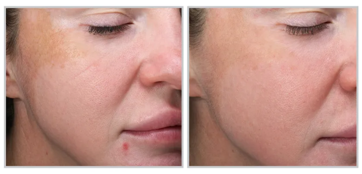 MOXI Laser Skin Rejuvenation Course of 3 (save 10%)