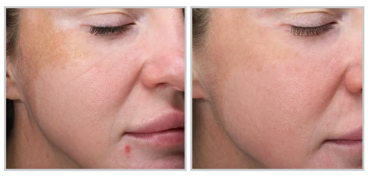 MOXI Laser Skin Rejuvenation save up to €700