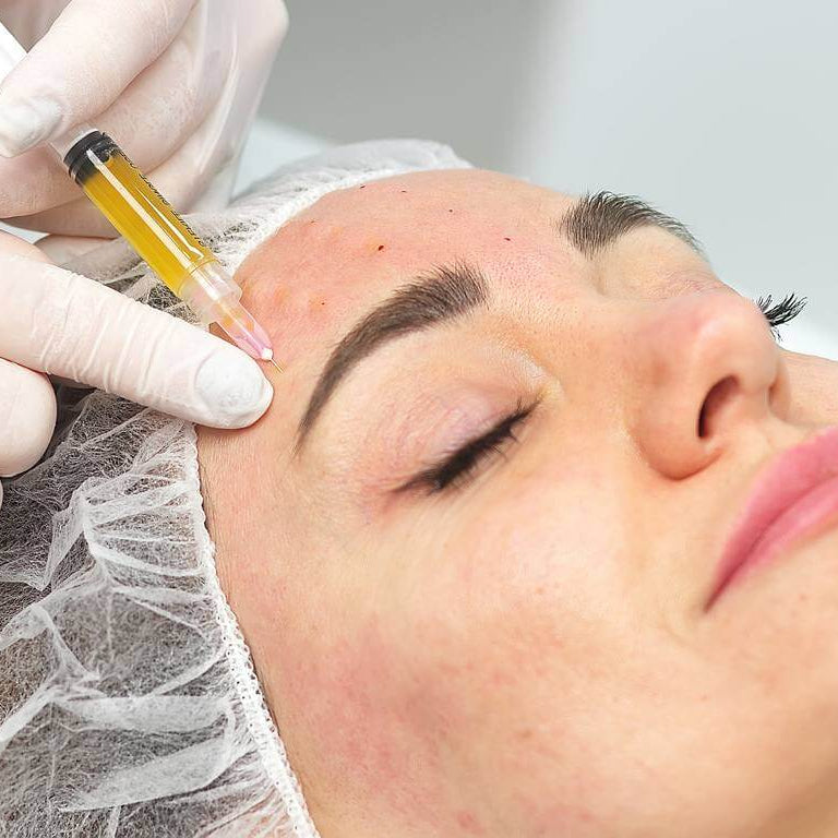 PRP (Platelet-Rich Plasma) for Face or Scalp (save €151)
