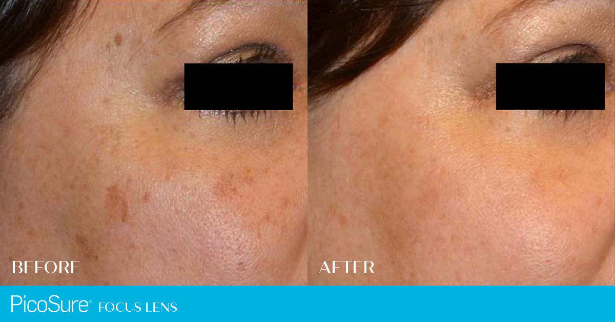 Picosure Laser Skin Rejuvenation Course of 6 (15% OFF)