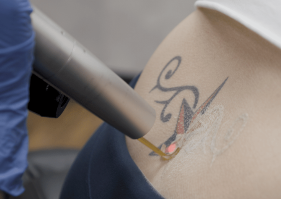 Consultation for Picosure Laser Tattoo Removal (Fee Redeemable)