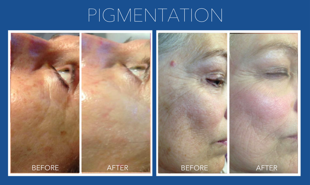 Microneedling with LED Light Therapy Course of 3 (save up to €456)
