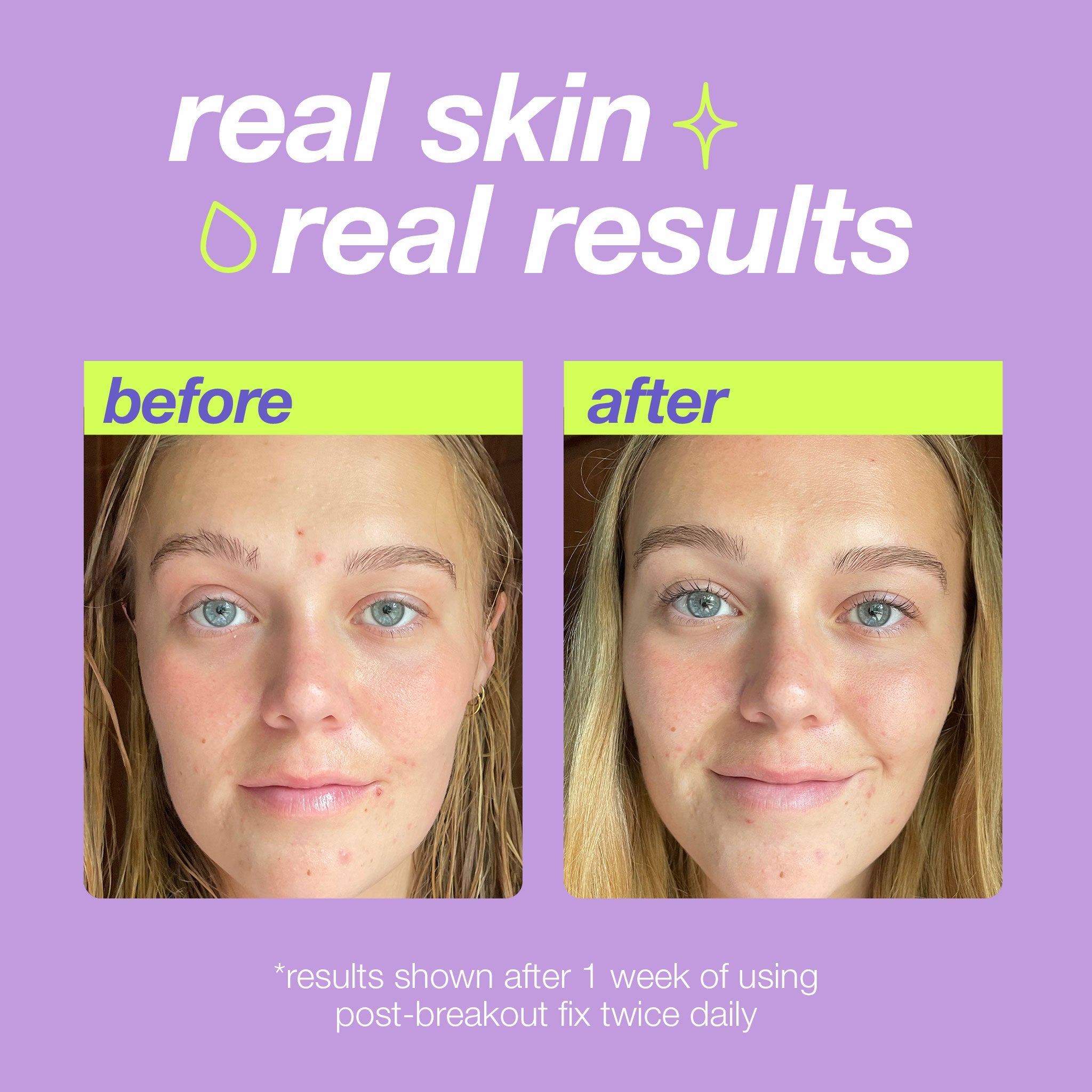 Dermalogica post-breakout fix