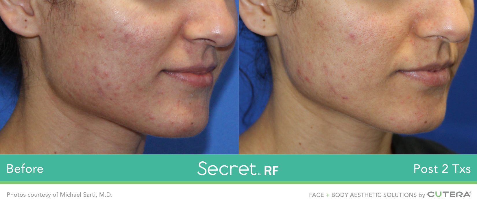 Secret RF +Microneedling for Full Face & Neck course of 2 (save €401)