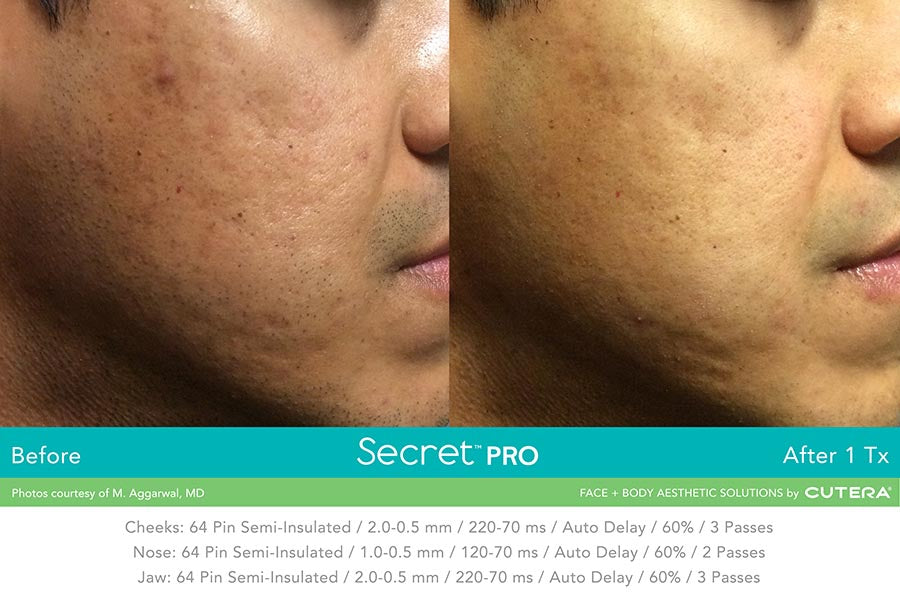 South William Stax: Secret RF +Microneedling & C02 Laser Combination for Full Face (save €651)