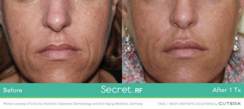 Secret RF +Microneedling for Full Face & Neck course of 2 (save €401)