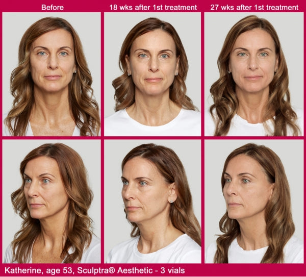 Sculptra Plump & Refresh Bio Stimulator Collagen Treatment (save €201)