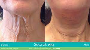Cutera Secret PRO CO2 Ablative Laser Resurfacing (save up to €751)