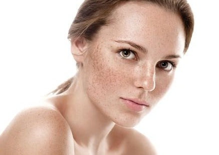 Pigmentation & Melasma Pack: BBL + MOXI + Peels for Face Course of 3 (save €1,251)