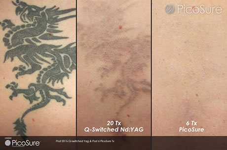 Picosure Laser Tattoo Removal Single Session