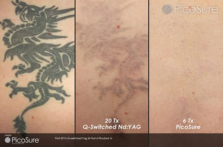 Picosure Laser Tattoo Removal Course of 6 (save 15%)
