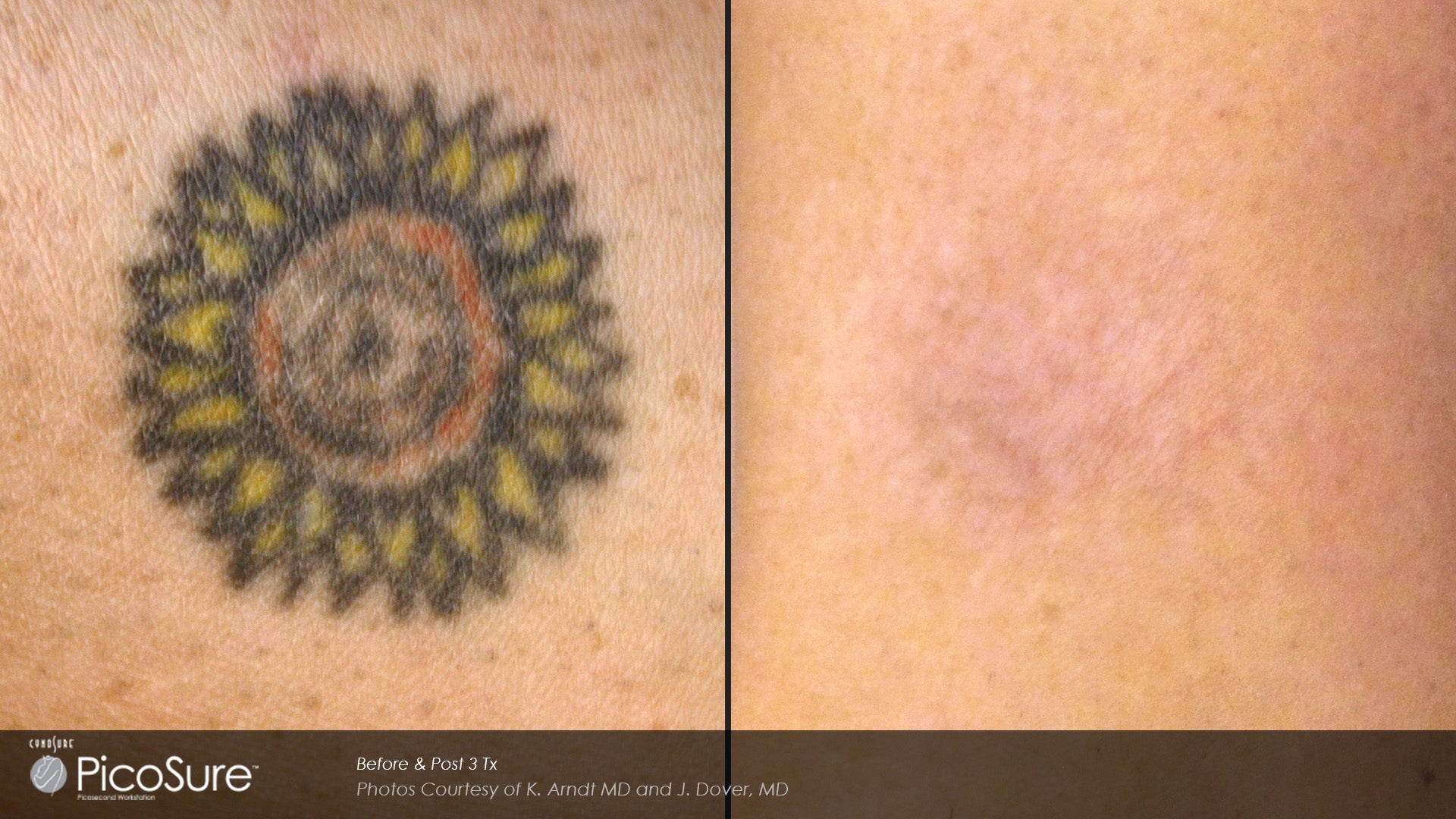 Picosure Laser Tattoo Removal Course of 6 (save 15%)