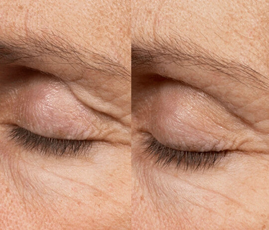 Thermage RF Anti-Ageing Skin Tightening Treatment (save €251)