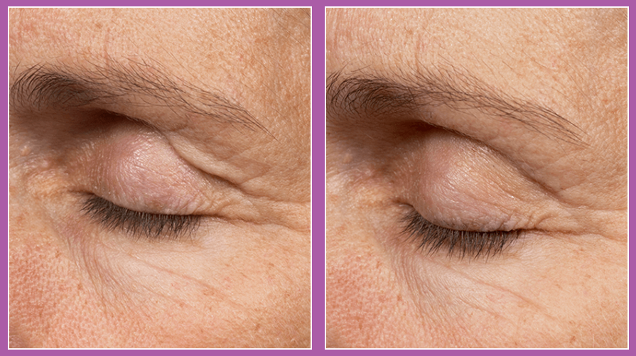 Thermage FLX RF Anti-Ageing Skin Tightening Treatment save up to €2,000