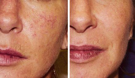 Laser thread vein reduction for small area course of 4 (save €301)