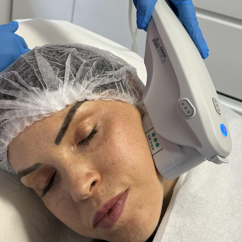 ultherapy.png__PID:ef8b706b-3e5e-48cf-8a5d-5f3bde4ab689