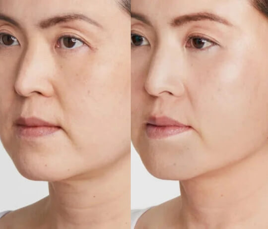 ultherapy before after south william clinic 2.jpg__PID:01031699-6632-4445-92f3-e1c14de0f7dd