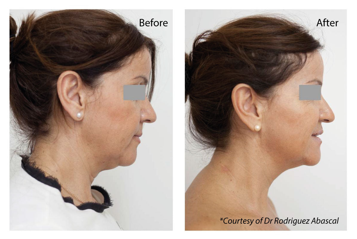 Profhilo Hyaluronic Acid Injections Two Treatments +Complimentary Neck Treatment (save €376)