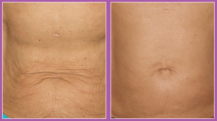 Thermage FLX full face and neck skin tightening (save €500)