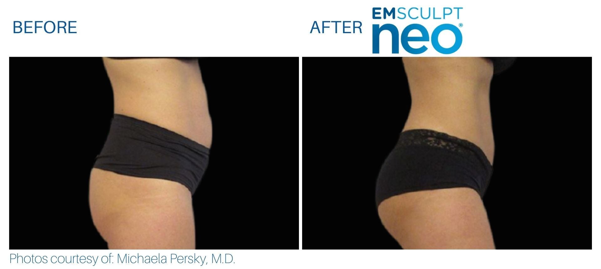 EmSculpt NEO Muscle Building & Fat Burning course of 6 (save €750)