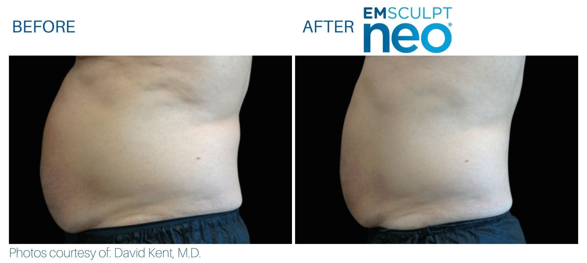 EmSculpt NEO Muscle Building & Fat Burning course of 6 (save €750)