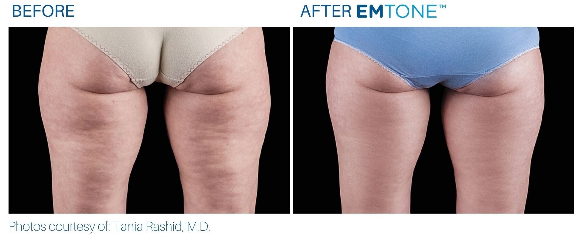 EmTone Skin Tightening & Cellulite Treatment (save up to €1,201)