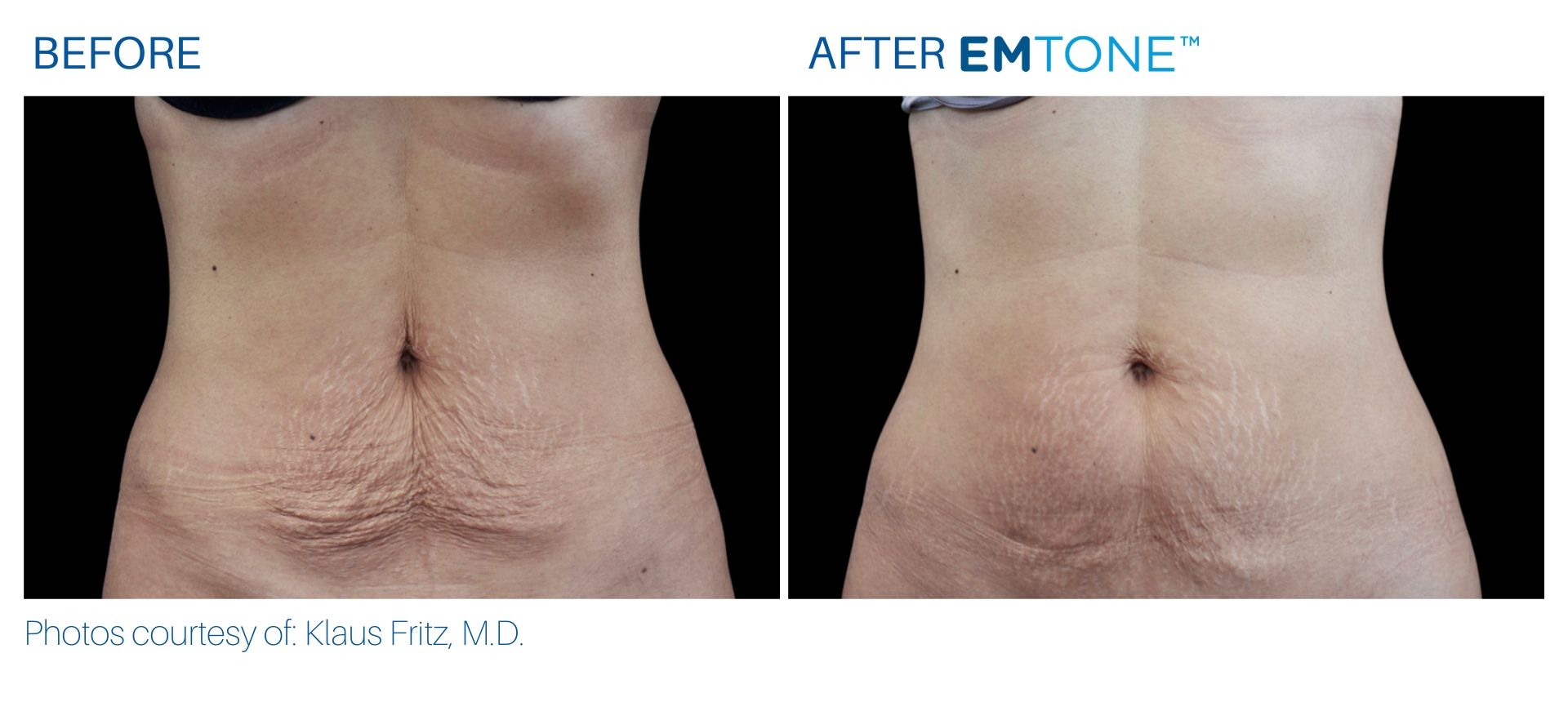 EmTone Skin Tightening & Cellulite Treatment (save up to €1,201)