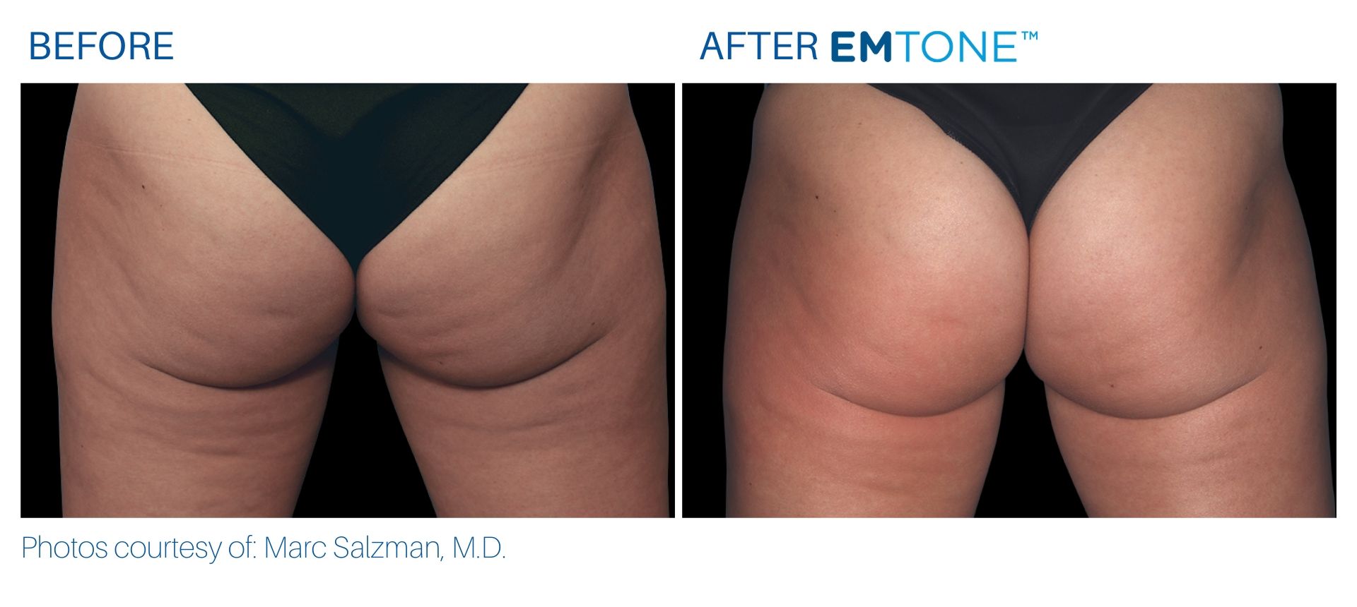 EmTone Skin Tightening & Cellulite Treatment (save up to €1,201)