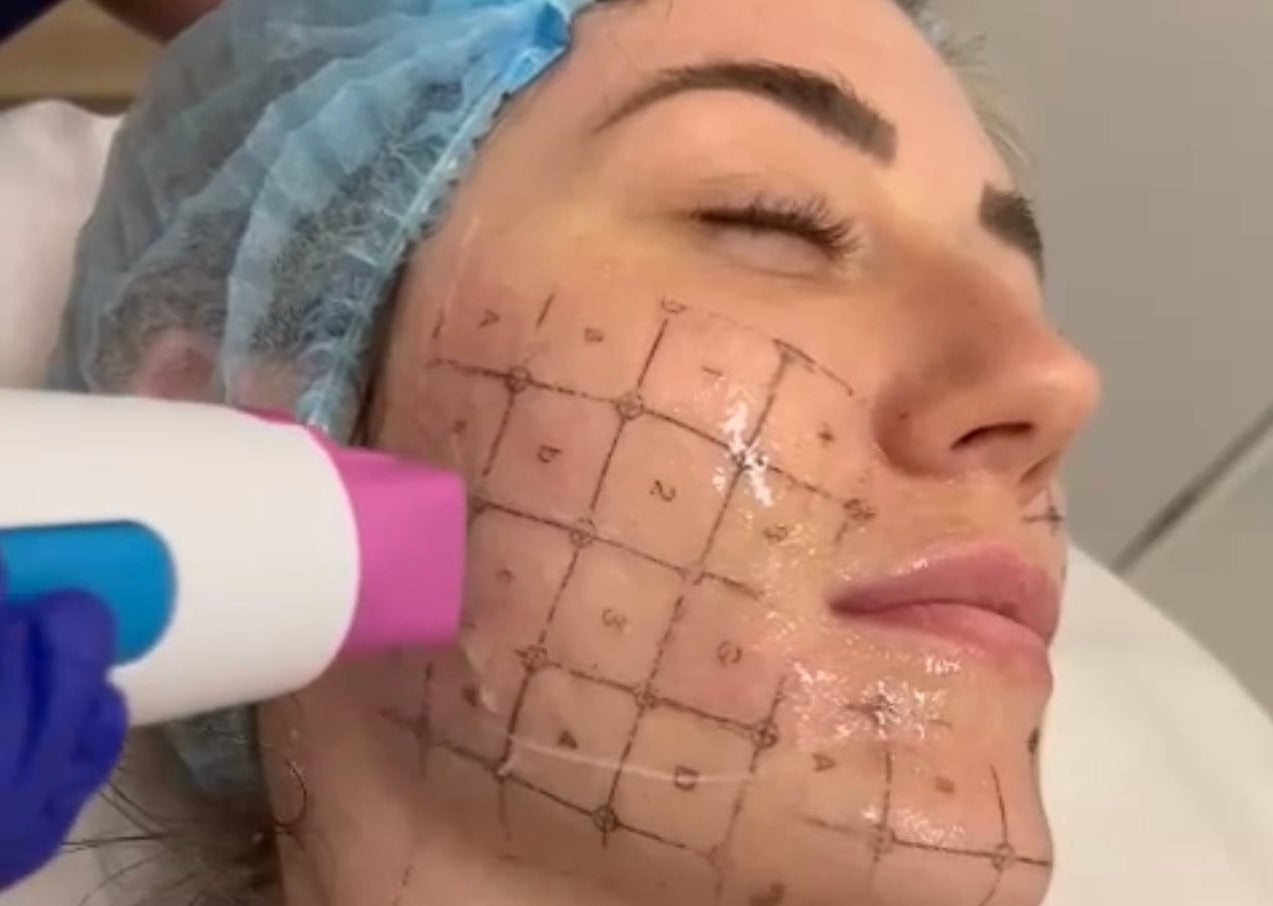 Thermage FLX full face or neck skin tightening