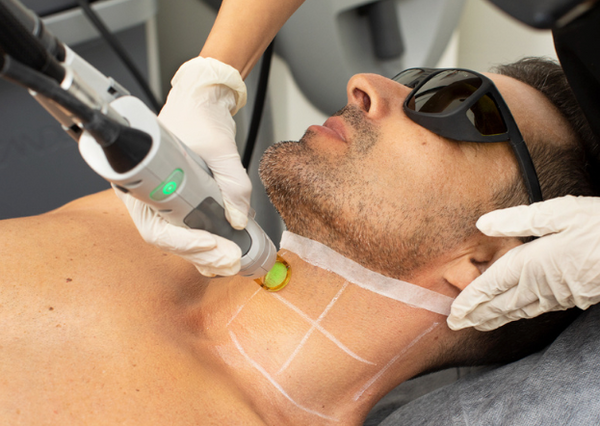 Laser Hair Removal Men s Facial Hair Package as low as 59.90 per ses