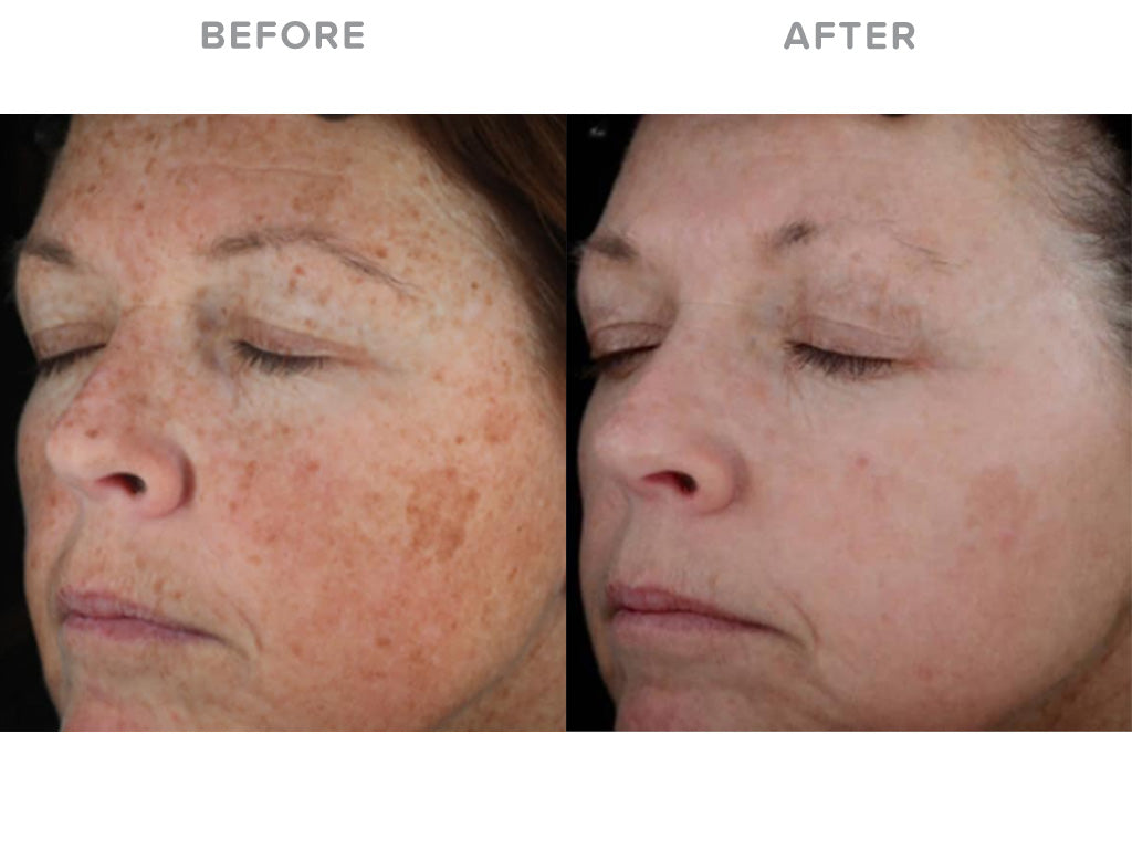 Laser skin rejuvenation for ageing, pigmentation and redness full face