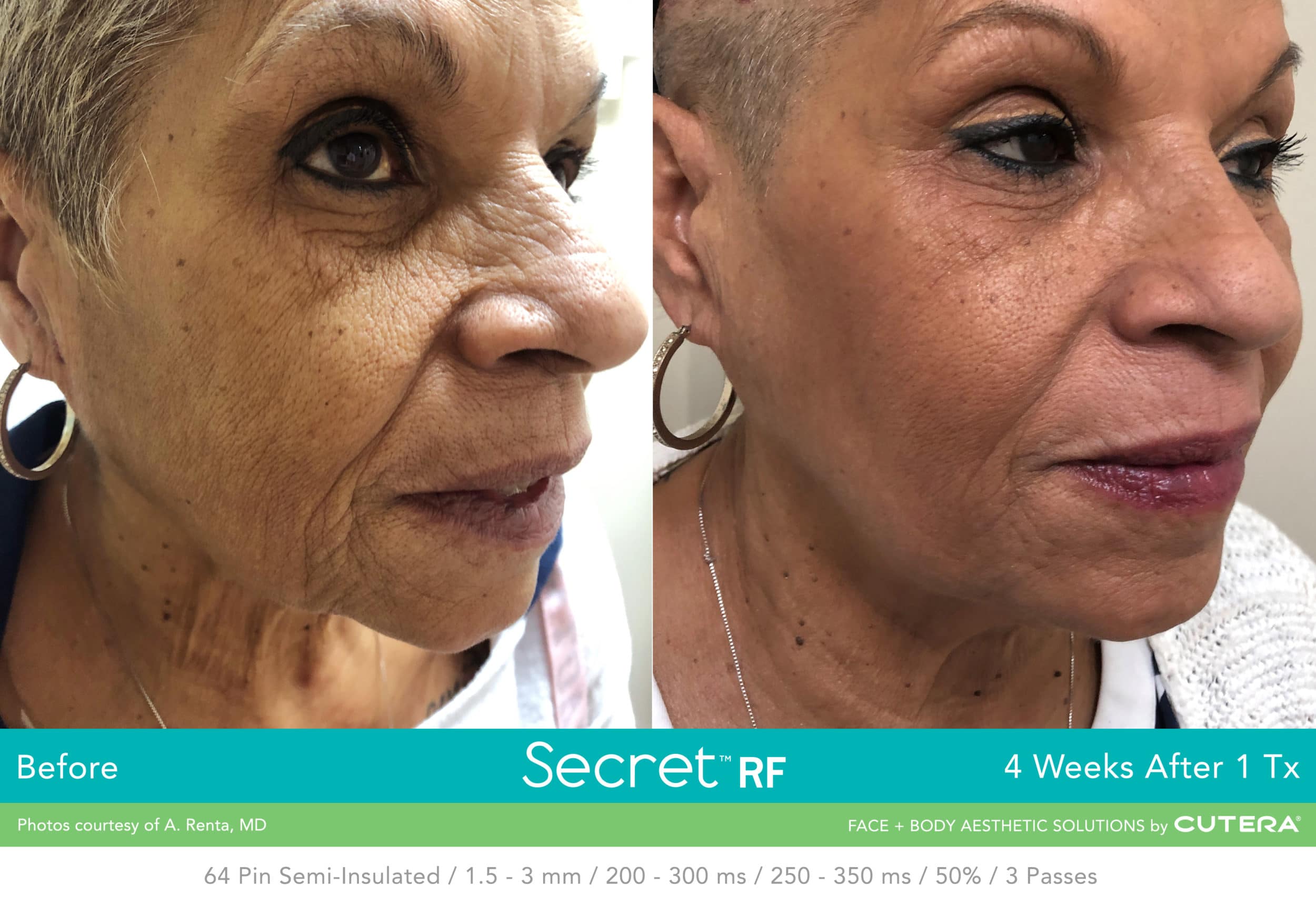 Secret RF +Microneedling Package with LED for Full Face & Neck course of 4 (save €1,720)