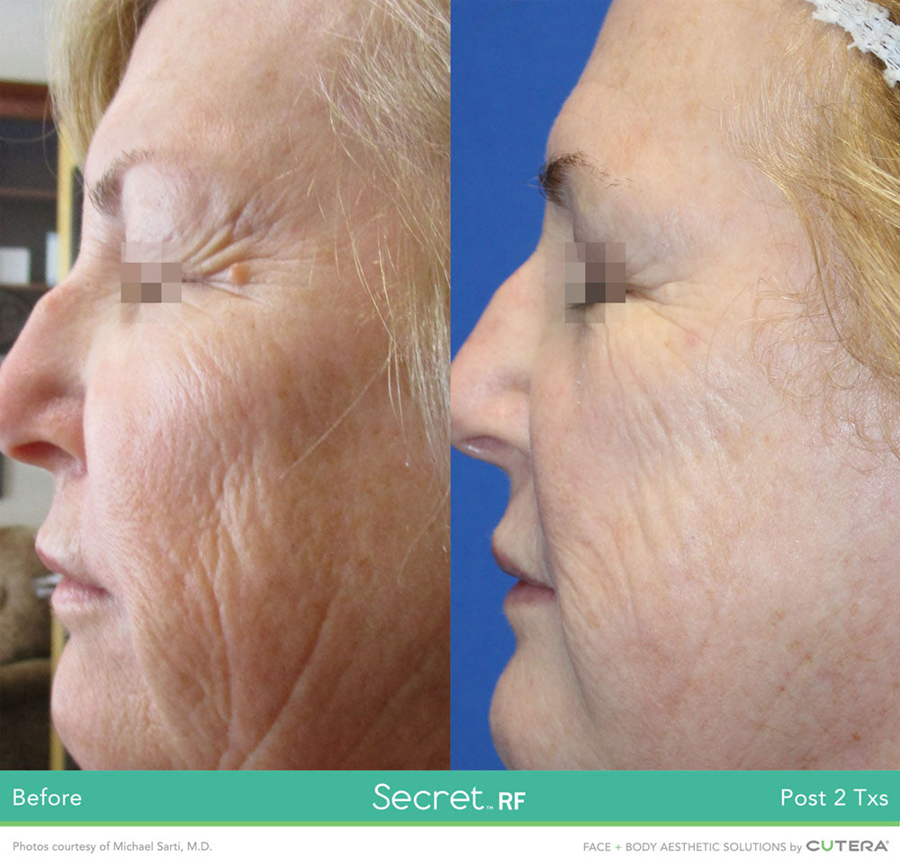 Secret RF +Microneedling Package with LED for Full Face & Neck course of 4 (save €1,720)