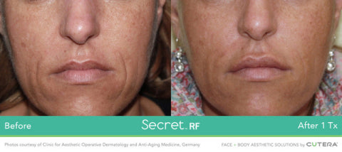 Secret RF +Microneedling Package with LED for Full Face & Neck course of 4 (save €1,720)