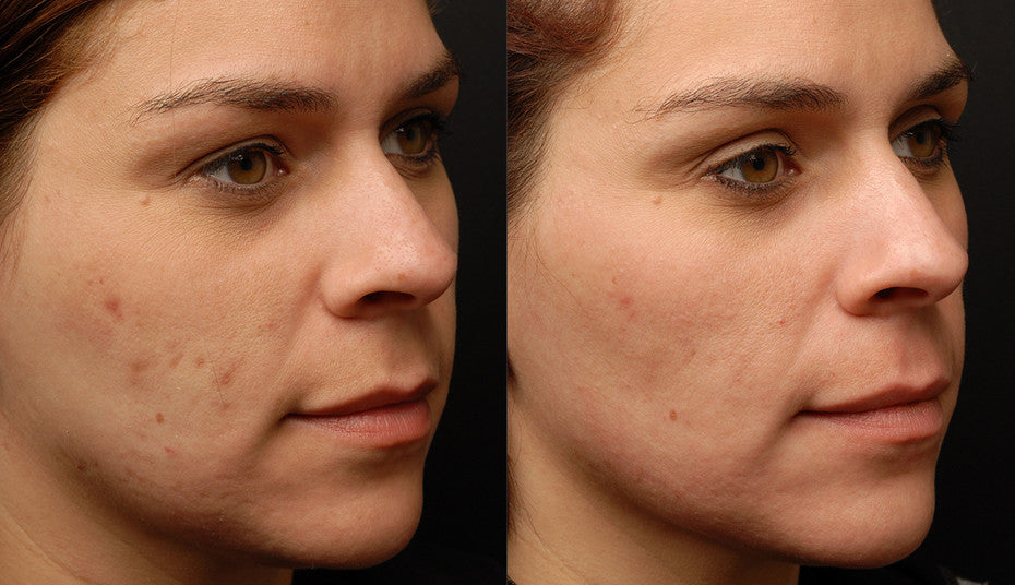 Sublative Skin Resurfacing course of 3