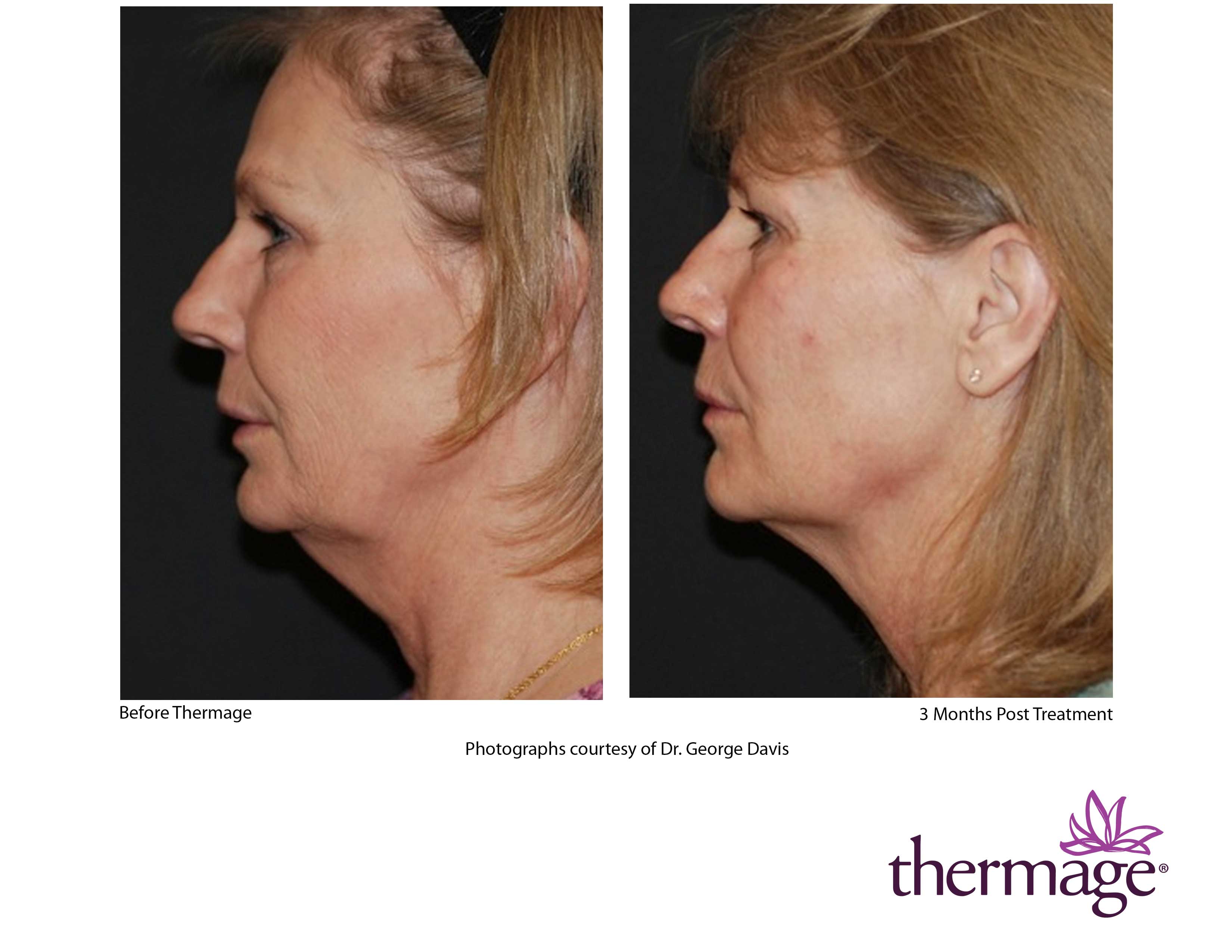 Thermage FLX full face and neck skin tightening (save €500)