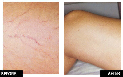 Laser thread vein removal for full legs course of 3+1 FREE (save €251)